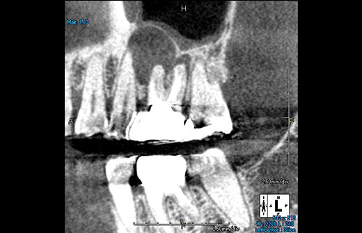 根尖病巣（歯根の先にできる膿の袋のこと）の位置と有無と状態