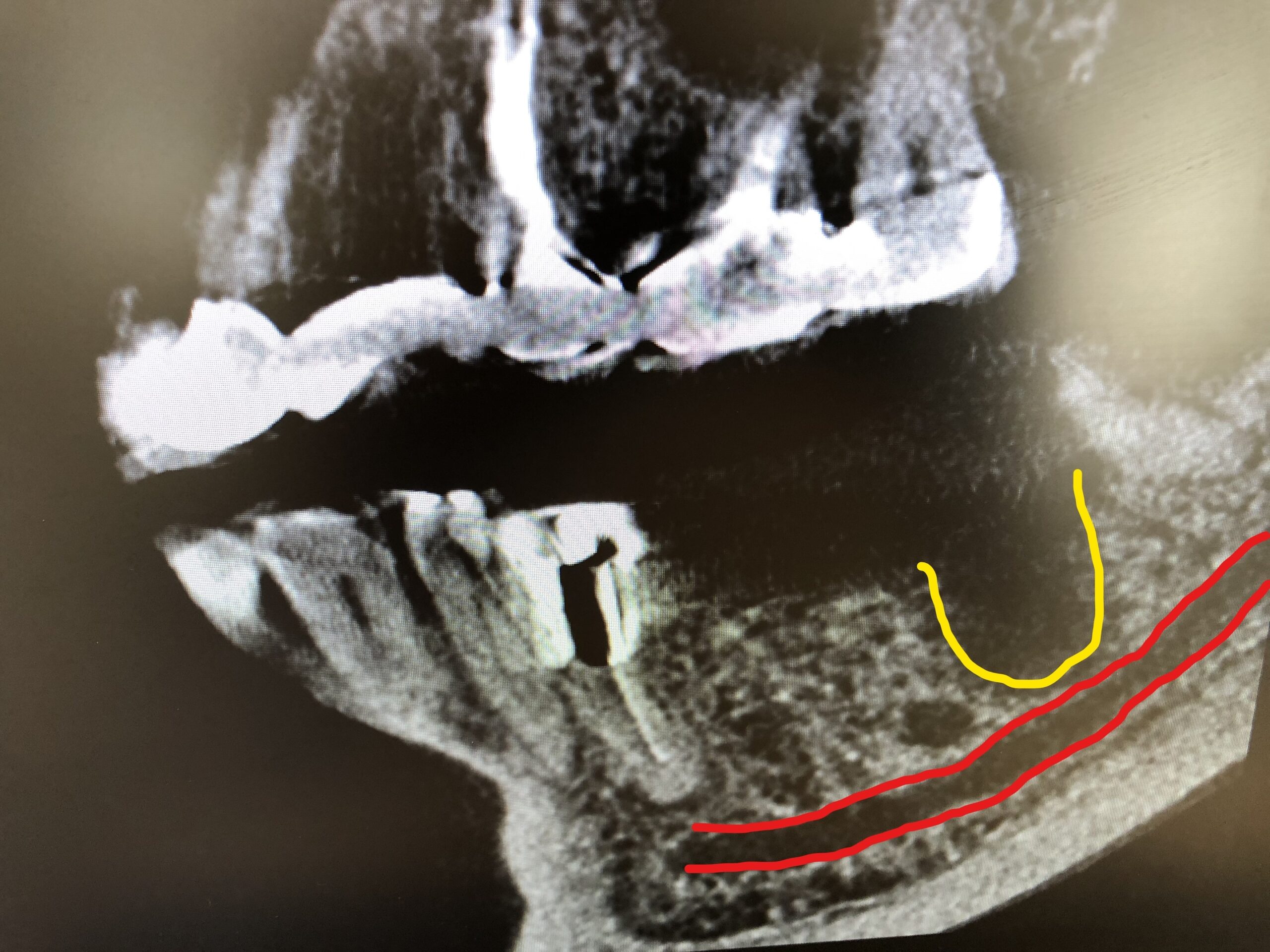 下顎奥歯のインプラント治療