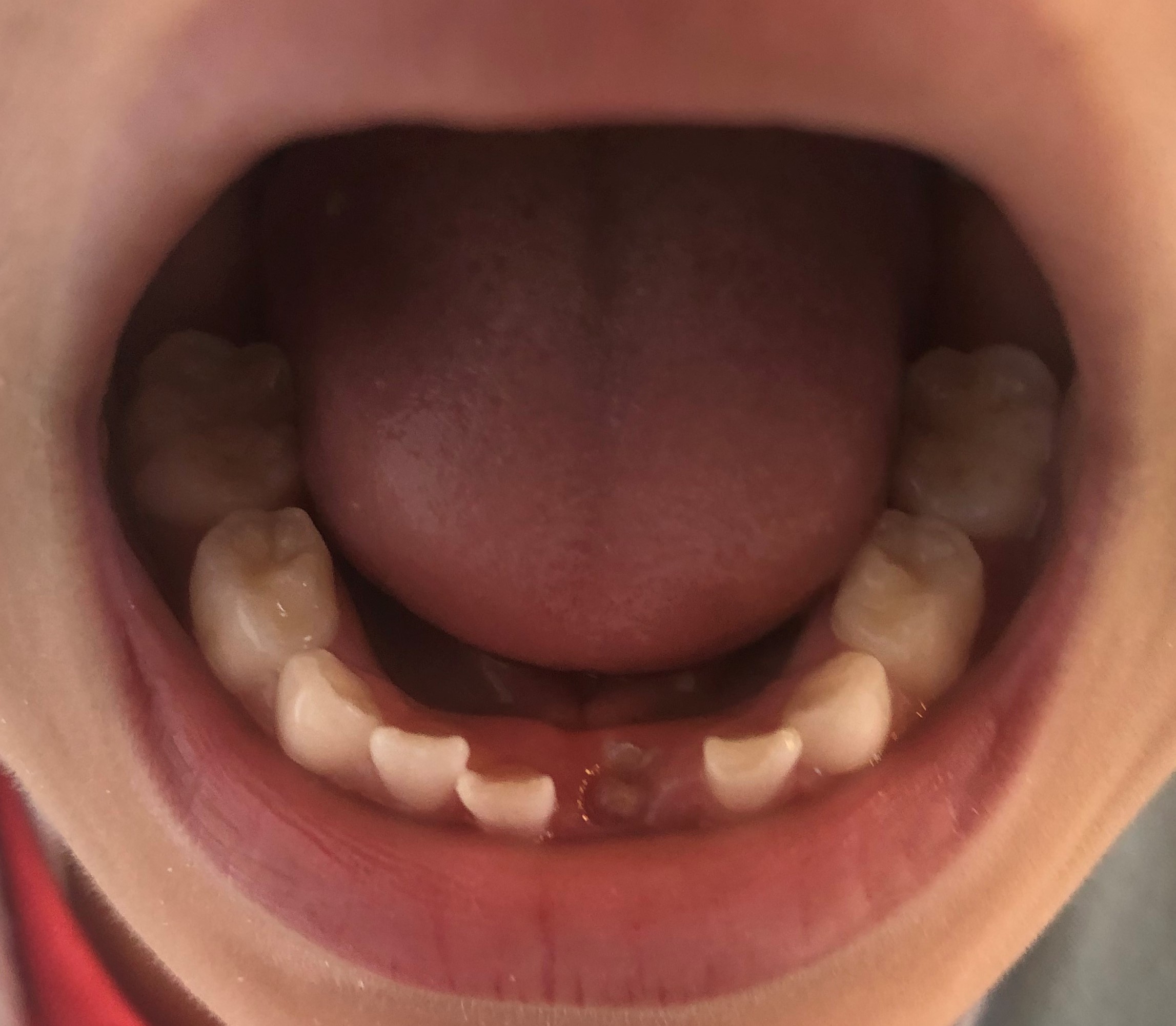 歯の生え変わり