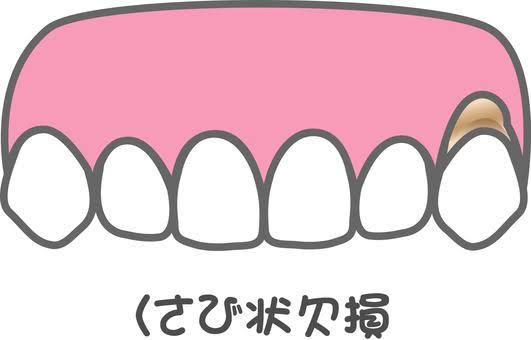 wsd（くさび状欠損）について